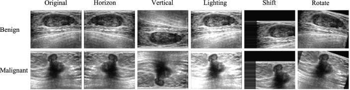A comparison chart showing breast ultrasound (BUS) images of benign and malignant tumors, demonstrating various data augmentation techniques for deep learning models. The chart is organized into two rows (Benign and Malignant) and six columns representing different image states: Original, Horizon (horizontal flip), Vertical (vertical flip), Lighting (brightness adjustment), Shift (spatial translation with padding), and Rotate.
The 'Original' benign tumor is characterized by an oval, circumscribed shape with smooth margins and a relatively homogeneous internal echotexture. In contrast, the 'Original' malignant tumor demonstrates an irregular, non-parallel orientation (taller-than-wide) with spiculated or angular margins and significant internal heterogeneity, indicating potential infiltration.
Each augmentation column illustrates how the visual features are transformed: 'Horizon' and 'Vertical' flips change the spatial orientation, 'Lighting' modifies the echogenicity contrast, 'Shift' introduces black-masked boundaries, and 'Rotate' alters the lesion's angle relative to the transducer plane. This educational visual is designed to showcase how varied data inputs help train neural networks like Fus2Net for robust clinical diagnostic classification.