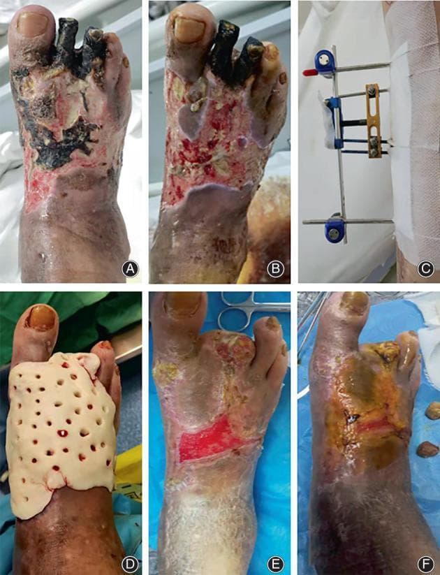 This series of clinical photographs (A-F) documents the surgical management and healing progression of a severely infected diabetic foot with localized gangrene. (A) Admission: Displays extensive dry and wet gangrene on the dorsal aspect of the foot, toes, and ankle with black necrotic eschar. (B) Post-debridement: Shows the removal of necrotic tissue and partial amputation of the second and third toes, revealing a raw, erythematous wound bed with viable granulation tissue. (C) mTTT Treatment: Illustrates the application of a metallic external fixator for transverse tibial bone transport to improve distal perfusion. (D) ABC Treatment: Shows the application of an Antibiotic-Loaded Bone Cement (ABC) spacer, appearing as a molded, perforated white material covering the wound surface for local infection control. (E) Discharge: Demonstrates significant wound contraction and the formation of a healthy pink epithelial layer. (F) Healing: Shows complete wound closure and re-epithelialization with residual hyperpigmentation and scarring. The sequence highlights a multidisciplinary approach combining surgical debridement, antibiotic spacers, and micro-tibia transverse transport (mTTT).