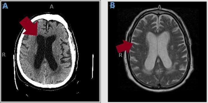 This figure presents two axial cross-sections of the brain highlighting neuroanatomical changes. Image A is a non-contrast Computed Tomography (CT) scan of the head demonstrating significant ventriculomegaly. A red arrow points to the markedly enlarged lateral and third ventricles, which occupy a disproportionate volume relative to the brain parenchyma. Image B is a T2-weighted Magnetic Resonance Image (MRI) with contrast from the same patient. This image clarifies the etiology of the ventricular enlargement, with a red arrow indicating pronounced cerebral atrophy. Key visual findings in image B include the prominent narrowing of cortical gyri and the compensatory widening of the sulci (hydrocephalus ex vacuo). The comparison between these two modalities is used to distinguish between communicating hydrocephalus and secondary ventricular enlargement due to global tissue loss. These diagnostic images are essential for evaluating geriatric patients presenting with the clinical triad of gait instability, urinary incontinence, and cognitive decline, often seen in normal pressure hydrocephalus (NPH) or neurodegenerative processes.