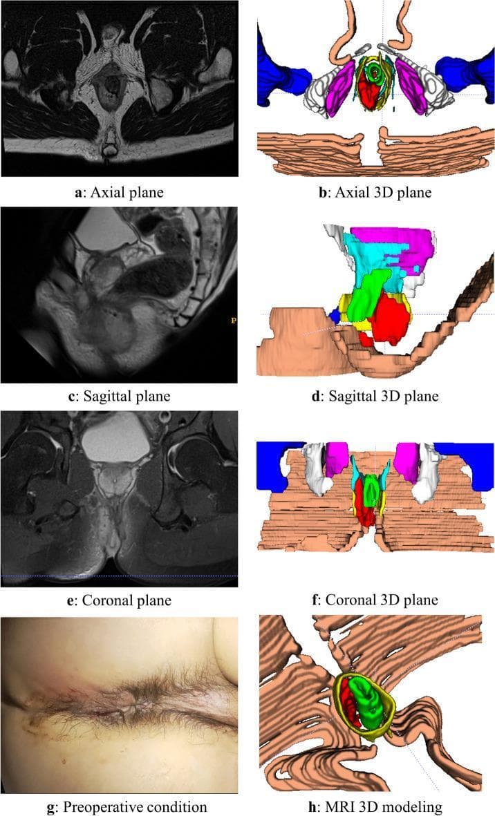 This composite educational image illustrates a case of an intersphincteric anorectal abscess through multi-modal diagnostic views. The panel includes original MRI scans and corresponding color-coded 3D reconstructions across axial (a, b), sagittal (c, d), and coronal (e, f) planes. The MRI images demonstrate the complex anatomy of the perianal region with the abscess appearing as a localized, high-signal intensity lesion on T2-weighted imaging. In the 3D models, the red structure represents the abscess, highlighting its spatial relationship to the anal canal, internal and external sphincters (represented by concentric green and yellow layers), and the levator ani muscle. Panel (g) provides a clinical photograph of the preoperative perianal region, and panel (h) displays a detailed 3D modeling view. This visual aid is designed to teach colorectal surgeons and radiologists the volumetric assessment and anatomical mapping of perianal fistulas and abscesses, emphasizing the value of 3D reconstruction in clarifying tissue demarcations that may be obscured in standard 2D grayscale radiology.