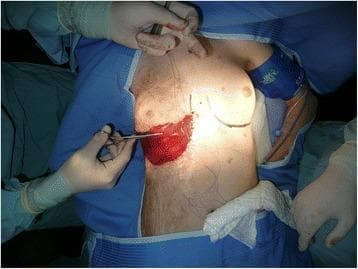 This clinical photograph captures an intraoperative view of a reconstructive surgical procedure on the right breast of a pediatric patient. The image illustrates the application of Integra Bilayer Wound Matrix—a dermal regeneration template—following the release of a post-burn contracture. The Integra material appears as a prominent, reddish-maroon rectangular patch positioned over the lower pole of the breast. It is secured to the surrounding skin margins with absorbable sutures. Surgical markings are visible on the adjacent skin, outlining the planned inframammary fold and surgical approach. A gloved surgeon’s hand is shown using a fine surgical instrument (possibly forceps or a needle driver) to manipulate the material or tissue. The surgical field is framed by sterile blue drapes and gauze. This visual demonstrates a key step in plastic and reconstructive surgery aimed at restoring skin elasticity and allowing for normal breast development in the context of restrictive burn scarring.
