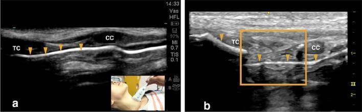 This diagnostic comparison image consists of two high-frequency airway ultrasound scans (a and b) in a longitudinal orientation, illustrating normal versus traumatic sonoanatomy of the larynx. Image 'a' demonstrates a normal airway with a continuous, linear hyperechoic interface (arrowheads) representing the intact air-mucosal interface. Key anatomical structures identified include the hypoechoic thyroid cartilage (TC) and cricoid cartilage (CC). Image 'b' displays pathological findings following blunt neck trauma. The air-mucosal interface is notably disrupted (arrowhead), indicating loss of mucosal integrity. A highlighted region (orange box) reveals a fracture of the cricoid cartilage and the development of an endolaryngeal hematoma, characterized by heterogenous echogenicity within the soft tissues. These images serve as an educational resource for medical professionals and students in emergency medicine and radiology to differentiate normal laryngeal anatomy from significant laryngeal trauma, such as cartilage fractures and internal soft tissue injuries, using point-of-care ultrasound (POCUS).