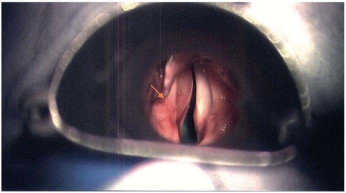 This clinical photograph shows a direct laryngoscopy endoscopic view of the human larynx, oriented with the anterior commissure at the top of the frame. The image illustrates a significant reddish, submucosal mass on the left side (indicated by an orange arrow), localized to the left vallecula and supraglottic region. The lesion exhibits a smooth, bulging morphology and extends toward the subepithelial area of the left vocal cord, resulting in visible anatomical asymmetry and partial narrowing of the glottic aperture (airway obstruction). In contrast, the right vocal cord and adjacent supraglottic structures appear relatively normal. This visual serves as a primary clinical example of a laryngeal mass—pathologically confirmed in this case as a schwannoma—demonstrating how localized benign tumors can displace laryngeal architecture and impinge upon the airway. This material is suitable for medical education in Otolaryngology regarding the endoscopic assessment of laryngeal tumors and differential diagnosis of airway obstruction.