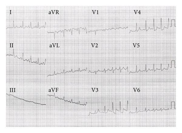 This diagnostic image is a 12-lead electrocardiogram (ECG) demonstrating the classic visual features of Wolff-Parkinson-White (WPW) syndrome following the administration of isoproterenol (Isuprel). The tracing displays a regular sinus rhythm with a shortened PR interval. A hallmark finding is the slurred upstroke of the initial QRS complex, known as a delta wave, which is most prominent in leads I, II, aVL, and V4 through V6. The QRS complexes exhibit mild widening as a result of this pre-excitation, where ventricular activation occurs via both the atrioventricular (AV) node and a left-sided accessory pathway. T-wave morphology shows variability, with upright T-waves in the lateral leads (I, aVL, V4-V6) and inversion in the right precordial leads (V1-V3) and lead aVR. This ECG serves as an educational example of pre-excitation syndrome morphology and the impact of adrenergic stimulation on AV and accessory pathway conduction.
