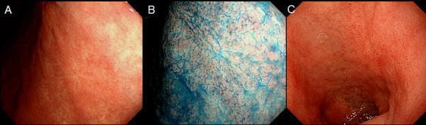 This set of three clinical endoscopic photographs illustrates the appearance of the upper gastrointestinal mucosa in the stomach and duodenal cap. Panel A shows the stomach lining under white light endoscopy, characterized by a smooth, reddish-pink mucosal surface with visible fine submucosal vascular patterns. Panel B demonstrates the same gastric area using chromoendoscopy with indigo-carmine dye. The blue contrast agent accumulates in the mucosal pits and crevices, highlighting the surface micro-architecture, mucosal folds, and subtle irregularities that may indicate previous pathology like healed peptic ulcer scars. Panel C provides a white light view of the duodenal cap, showing a similar pinkish hue but with more pronounced anatomical folds compared to the gastric body. The image set is designed for gastroenterology education to demonstrate the utility of chromoendoscopy in enhancing mucosal detail and identifying chronic changes or scars from previous peptic ulcer disease (PUD) that might be subtle under standard white light imaging.