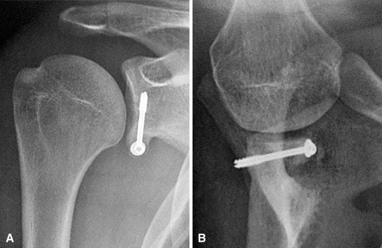 Two-panel postoperative radiographic study of the right shoulder demonstrating successful Bristow-Latarjet-Bankart procedure for recurrent anterior shoulder instability. Panel A is an anteroposterior (AP) view showing a coracoid bone graft fixated to the anteroinferior glenoid rim with a single radiopaque orthopedic screw. The graft is positioned optimally below the glenoid equator and flush with the articular surface. Panel B is a lateral (Bernageau) or scapular Y-view, illustrating the horizontal trajectory of the fixation screw through the bone block into the glenoid neck. There is visible evidence of osseous integration and bone healing between the transferred coracoid process and the native glenoid. The humeral head is centered within the glenohumeral joint, indicating restored stability and the successful recreation of the glenoid's concave architecture. This visual serves as an educational example of ideal bone block positioning to address severe glenoid bone deficiency.