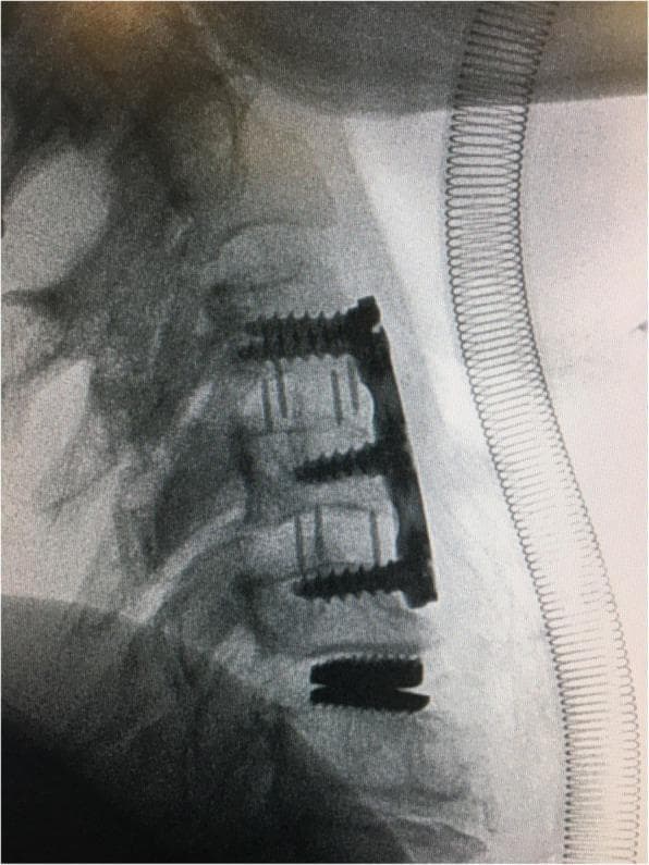 A lateral view plain radiograph of the cervical spine demonstrating a hybrid surgical construction for multilevel degenerative disc disease. The superior segment shows an anterior cervical discectomy and fusion (ACDF) construct at the C3–C4 and C4–C5 levels. This construct consists of a radiopaque anterior cervical plate anchored by five vertebral screws and interbody spacers with visible vertical markers to maintain disc height and promote arthrodesis. Immediately inferior at the C5–C6 level, a cervical disc prosthesis (artificial disc replacement) is visualized. The prosthesis consists of two radiopaque metallic endplates that articulate with the adjacent vertebral bodies, designed to preserve segmental motion while restoring disc space height. The image highlights a hybrid surgical approach that combines rigid stabilization through fusion at upper levels with motion-preserving arthroplasty at a lower level. An endotracheal tube with a visible coiled reinforcement is also present anterior to the spine.
