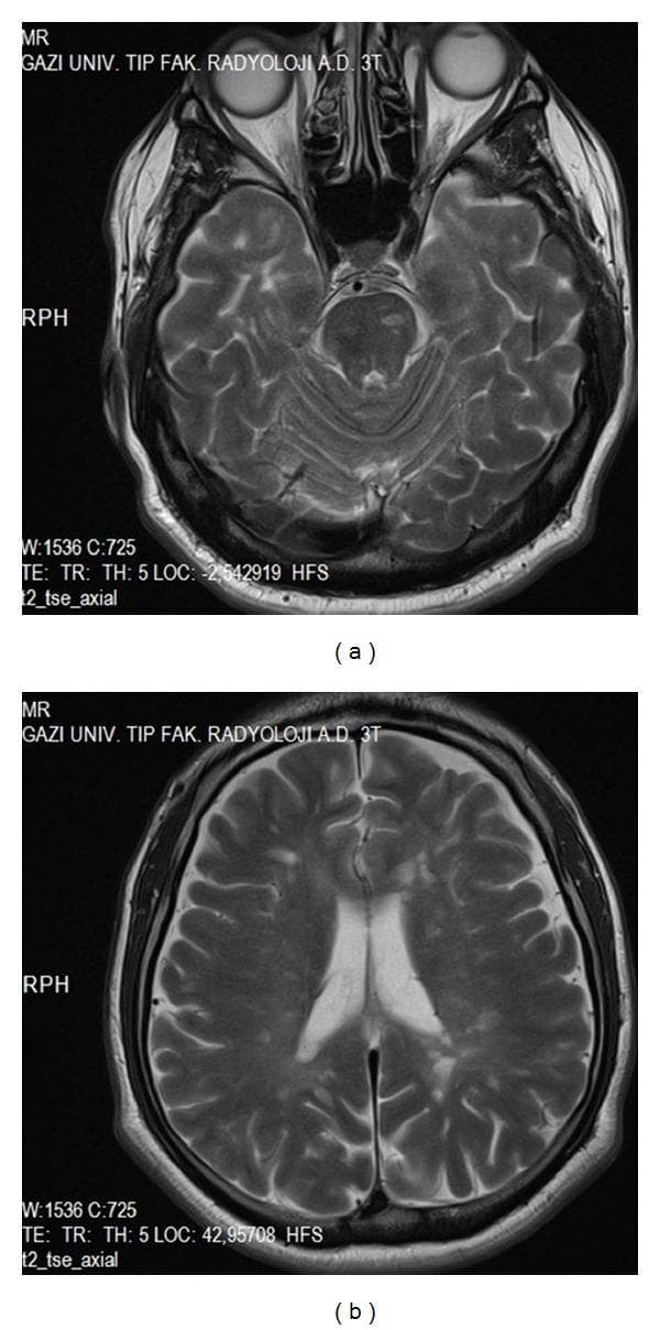 This composite diagnostic image consists of two T2-weighted axial sections from a 3T brain MRI demonstrating clinical features of a demyelinating disease, such as Multiple Sclerosis (MS). Image (a) is an axial section at the level of the posterior fossa, showing a focal area of increased signal intensity (hyperintensity) within the pons, consistent with an infratentorial demyelinating plaque. Image (b) shows a higher axial section at the level of the lateral ventricles, revealing multiple small, discrete hyperintense lesions within the periventricular white matter. These periventricular plaques are characteristic findings in neuroinflammatory disorders. The presence of lesions in both the brainstem and the supratentorial white matter illustrates dissemination in space, a key diagnostic criterion for multiple sclerosis. These images serve as a classic radiological representation of demyelination in the central nervous system for medical educational purposes in neurology and radiology.