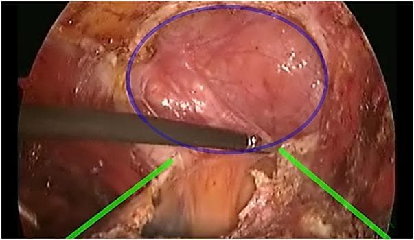 This endoscopic clinical photograph captures an intraoperative view during an Enhanced-View Totally Extraperitoneal (eTEP) ventral hernia repair. The image highlights a central hernia defect within the abdominal wall, demarcated by a blue circular annotation. Within this circle, the hernia sac appears as a translucent, reddish-pink tissue layer. A laparoscopic surgical instrument, a Maryland-style or blunt dissector, is seen performing active dissection at the inferior margin of the defect. Green lines illustrate the cut edges of the posterior rectus sheath, which appears as a more opaque, whitish-fibrous structure compared to the thin peritoneal sac. This visual demonstrates the surgical technique of preserving the hernia sac in continuity with the posterior rectus sheath to facilitate a tension-free closure of the posterior layer in cases with large defects or significant midline separation.