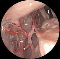 This diagnostic clinical image, likely obtained via endoscopic laryngoscopy, illustrates the complex vascular anatomy of the left larynx. The photograph focuses on the branching patterns of the superior laryngeal artery (SLA) in relation to key endolaryngeal structures. Visible landmarks include the epiglottis (E) superiorly, the laryngeal lumen (L), the left arytenoid region (AL), and the thyroid cartilage (T). A specific branch of the SLA is highlighted, demonstrating a caudal and lateral course marked with an asterisk (*). This vessel is seen traversing the paraglottic space and exiting the larynx in close proximity to the lower horn (H) of the thyroid cartilage. The image serves as an educational tool for identifying surgical landmarks and understanding the varied arterial supply to the laryngeal mucosa and intrinsic muscles, which is critical for phonosurgery and oncologic resections to avoid intraoperative hemorrhage.