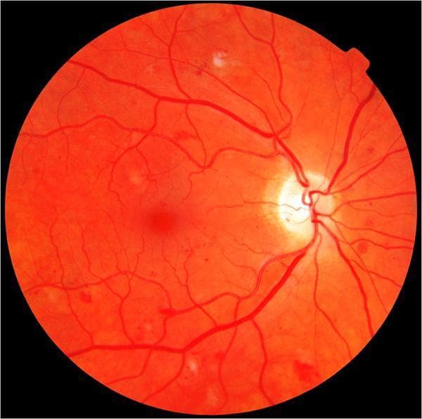 A color fundus photograph of the human retina demonstrating features of moderate non-proliferative diabetic retinopathy (NPDR). The image reveals an orange-red retinal background with several distinct pathological findings. Scattered punctate microaneurysms and small dot-and-blot hemorrhages are visible across the posterior pole. In the superior and peripheral regions, multiple cotton wool spots—characterized as fluffy, white, indistinct lesions—are present, indicating focal areas of retinal nerve fiber layer ischemia. The retinal vasculature exhibits mild to moderate tortuosity without evidence of neovascularization. The optic disc appears pale with well-defined margins and a normal cup-to-disc ratio. The macula appears relatively preserved without gross hard exudates or clinically significant macular edema in this view. This clinical photograph is a primary diagnostic tool for ophthalmologists and medical students to identify the progression of diabetic microvascular disease and differentiate between mild and moderate NPDR stages based on the quantity and variety of lesions such as hemorrhages and cotton wool spots.