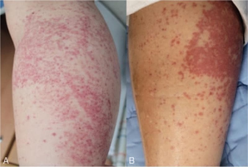 This clinical comparison photograph displays two panels (A and B) showing the progression of skin lesions on the lower leg of a patient diagnosed with IgA vasculitis (Henoch-Schönlein purpura). Panel A illustrates the acute presentation with diffuse, vibrant erythematous macules and papules that are extensively scattered and partially coalescent, forming larger inflammatory patches. Panel B shows the same anatomical region at a later stage, demonstrating a reduction in the density of the rash, though persistent palpable purpura and a localized area of intense confluent erythema remain visible. The image demonstrates the classic cutaneous manifestation of leukocytoclastic vasculitis, characterized by non-blanching red-to-purple lesions typically found in dependent areas. This visual aid is intended for medical education regarding the clinical recognition of systemic vasculitis and its dermatologic evolution during treatment.