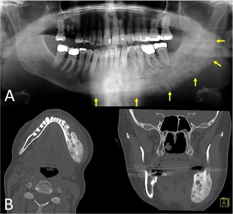 This composite educational image features a panoramic dental radiograph (A) and multiplanar CT scans (B) of a 50-year-old patient with chronic osteomyelitis of the left mandible. Panel A shows a panoramic X-ray demonstrating significant distension and deformity of the left hemimandible. Multiple yellow arrows indicate a mixed radiopaque and radiolucent appearance extending from the right parasymphyseal/premolar region to the posterior ramus, characterizing a combination of bone sclerosis and osteolytic destruction. Panel B contains axial and coronal CT slices that provide detailed visualization of the mandibular pathology. The left hemimandible exhibits marked cortical expansion and a heterogeneous internal structure. Notable features include increased bone marrow attenuation and irregular sclerotic masses interspersed with lucent areas, consistent with proliferative periostitis and reactive new bone formation. The right side of the mandible serves as a normal anatomical comparison, appearing non-expanded with clear cortical borders. This imaging illustrates the typical radiological features of secondary chronic osteomyelitis and proliferative periostitis in the maxillofacial region.