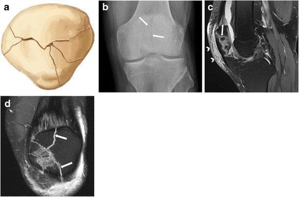 This composite educational resource illustrates a non-displaced stellate patellar fracture through four complementary views: (a) a medical illustration showing multiple radiating fracture lines, (b) an anteroposterior (AP) radiograph of the knee, (c) a sagittal fat-suppressed proton density (PD) MRI, and (d) a coronal fat-suppressed PD MRI. The AP radiograph reveals subtle lucent lines within the patella body (arrows). The MR images provide superior visualization of the multi-fragmentary, comminuted fracture pattern without significant displacement of the osseous fragments. The sagittal MRI (c) highlights hyperintense signal intensity in the prepatellar soft tissues (arrowheads), characteristic of subcutaneous oedema resulting from direct blunt trauma. This series serves as a clinical teaching tool for musculoskeletal radiology, emphasizing that patellar fractures occult or subtle on conventional radiography are better characterized using advanced imaging like MRI to assess for articular involvement and associated soft tissue injury.