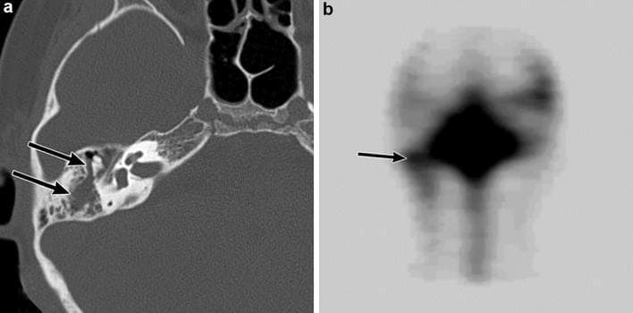 This composite educational image demonstrates a cerebrospinal fluid (CSF) leak into the right temporal bone in a pediatric patient with recurrent bacterial meningitis. Panel A is an axial computed tomography (CT) scan of the temporal bone in a bone window. It shows opacification of the right middle ear and mastoid air cells due to soft tissue density fluid collection (black arrows), contrasting with the normally air-filled spaces. While no acute fracture is visible, the findings suggest a traumatic or congenital pathway for CSF. Panel B displays a radionuclide cisternography scan following lumbar administration of a tracer. A focal area of increased radionuclide accumulation is clearly visible in the region of the right middle ear and mastoid cells (black arrow), providing definitive functional evidence of a CSF leak. The image highlights the diagnostic synergy between anatomical imaging (CT) and functional imaging (nuclear medicine cisternography) in identifying predisposing conditions for meningitis, such as post-traumatic skull base defects.