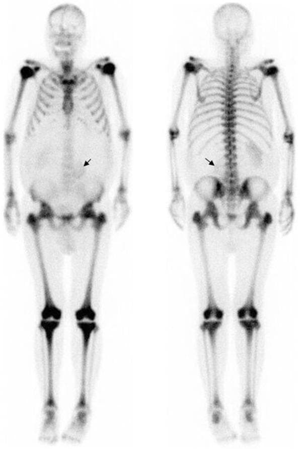 This diagnostic image is a whole-body nuclear medicine bone scan using 99mTc-hydroxydiphosphonate (HDP), showing both anterior and posterior projections. The image demonstrates a classic 'superscan' appearance, characterized by diffuse, intensely increased radiotracer uptake throughout the entire axial and appendicular skeleton. This intense skeletal uptake is accompanied by a near-total absence of normal physiological tracer distribution in the soft tissues and a lack of tracer excretion by the kidneys. In the abdominal region, a black arrow indicates the inferior displacement of the left kidney, caused by mass effect from massive splenomegaly. This constellation of findings—diffuse osteosclerosis reflected as a bone superscan combined with massive splenomegaly—is highly suggestive of a myeloproliferative neoplasm such as primary myelofibrosis, which can also involve extramedullary hematopoiesis. The visual focus is on the extreme metabolic activity of the bone marrow space across all visualized skeletal structures including the skull, spine, pelvis, and long bones.