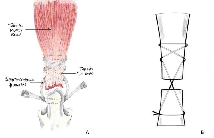 This orthopaedic illustration depicts the Bunnell suture repair technique used for triceps tendon ruptures. Image A is a detailed anatomical drawing showing the triceps muscle belly in red, distal triceps tendon, and a semitendinosus allograft. The allograft is looped around the triceps tendon and secured to the distal bone (olecranon) using the Bunnell technique. The repair features non-absorbable sutures woven in a characteristic criss-cross, figure-of-eight pattern (whipstitch) through the tendon substance to provide high tensile strength and minimize suture pullout. Image B provides a simplified schematic diagram of the same Bunnell stitch configuration, highlighting the 'X' shaped intersections of the suture and the horizontal locking components that bridge the gap between two ends of a ruptured tendon or a tendon-bone interface. This visual material is intended for orthopedic education regarding surgical management of tendon injuries and biomechanical stability in ligamentous repair.