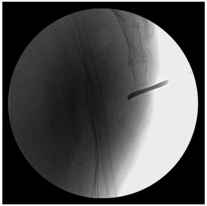 This lateral view intraoperative fluoroscopic image demonstrates a surgical reduction procedure for an anteriorly dislocated coccyx in a 56-year-old male. The imaging modality displays various grayscale densities, with the stacked radiopaque segments of the distal sacrum and coccygeal vertebrae visible in the right-central field. A distinct, radiopaque, elongated, and slightly curved instrument, identified as a Freer periosteal elevator, is seen inserted percutaneously. The elevator is positioned to act as a lever (joystick technique), with its tip placed near the anterior aspect of the sacrococcygeal joint to facilitate posterior realignment of the dislocated coccygeal segment. The surrounding soft tissues appear as diffuse, less dense shadows. This visual serves as an educational example of orthopedic trauma management, specifically demonstrating a minimally invasive surgical approach to manual reduction of traumatic coccygeal dislocation when closed rectal manipulation has failed.