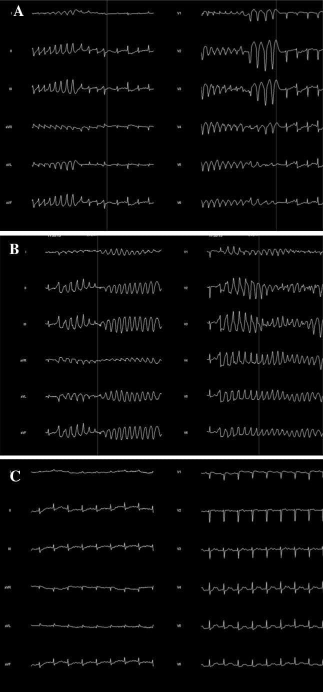 A three-panel 12-lead electrocardiogram (ECG) tracing demonstrating the evolution and features of polymorphic ventricular tachycardia. Panel A shows the initiation phase with a short-long-short R-R interval sequence, a common precursor to malignant arrhythmias. Panel B displays Torsades de Pointes (TdP), characterized by a rapid, irregular rhythm with wide QRS complexes that appear to 'twist' around the isoelectric line, varying in amplitude and morphology across leads II, III, aVF, and the precordial leads V2-V6. Panel C represents a baseline or post-event rhythm showing significant QT interval prolongation (long QT syndrome), which predisposes the patient to these ventricular events. The image illustrates critical electrophysiological findings relevant to cardiovascular medicine and emergency critical care, specifically the relationship between repolarization abnormalities and the onset of life-threatening polymorphic ventricular tachycardia.
