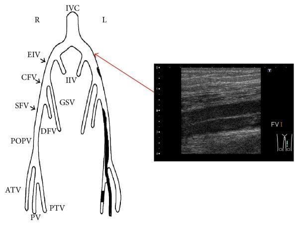 This composite image consists of an anatomical diagram and a corresponding diagnostic ultrasound, illustrating the deep venous system of the lower extremities. The left side features a schematic representation of the venous anatomy starting from the inferior vena cava (IVC), bifurcating into the internal (IIV) and external iliac veins (EIV). It follows the progression down to the common femoral vein (CFV), superficial femoral vein (SFV), deep femoral vein (DFV), great saphenous vein (GSV), popliteal vein (POPV), and distal leg veins (ATV, PTV, PV). The left leg in the diagram contains dark shaded regions representing deep vein thrombosis (DVT) extending from the iliac to the popliteal segments. A red arrow connects the left external iliac region to a B-mode ultrasonography image on the right. The ultrasound shows a longitudinal view of a leg vein with a hypoechoic lumen and hyperechoic walls. The absence of significant echogenic material within the lumen indicates a reduction in thrombus burden following anticoagulant therapy and endovascular treatment (EVT). This figure is intended for educational use in vascular medicine and radiology to demonstrate DVT localization and therapeutic monitoring.