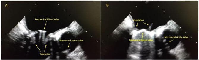 This diagnostic image consists of two side-by-side transesophageal echocardiography (TEE) frames (labeled A and B) captured at 120 degrees, focusing on the mitral and aortic valve regions. The ultrasound demonstrates a mechanical prosthetic bileaflet mitral valve characterized by bright, linear echogenic signals with acoustic shadowing. Pathological findings include multiple, large, irregular, and heterogeneous masses consistent with vegetations attached to both the atrial and ventricular surfaces of the mechanical mitral valve leaflets. In image A, vegetations are seen protruding downward into the left ventricle, while image B shows superiorly projecting masses. Adjacent to the mitral apparatus, a second echogenic mechanical prosthetic aortic valve is visible. These findings are clinically indicative of prosthetic valve endocarditis (PVE). This image serves as an educational tool for identifying cardiac vegetations, recognizing the appearance of mechanical valves on ultrasound, and diagnosing infectious complications following valve replacement surgery.