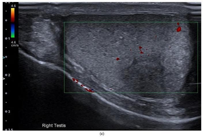 This color Doppler ultrasound image of the right testis demonstrates a solitary intratesticular mass, highly characteristic of a primary testicular germ cell tumor such as a seminoma. On grayscale imaging, the lesion appears as a predominantly hypoechoic and homogeneous mass with well-defined but slightly irregular margins. There is a notable absence of macroscopic calcifications or cystic components within the visible portion of the tumor. The color Doppler overlay shows internal vascularity, evidenced by scattered red flow signals within the mid-portion and periphery of the mass. Additionally, prominent vascularity is noted along the inferior boundary of the testis. This visual evidence supports the diagnostic workup for testicular malignancies in patients presenting with scrotal masses or secondary metastatic findings, such as retroperitoneal lymphadenopathy. The homogeneity and low echogenicity are typical sonographic features used by clinicians to differentiate seminomatous from non-seminomatous germ cell tumors, the latter of which tend to be more heterogeneous.