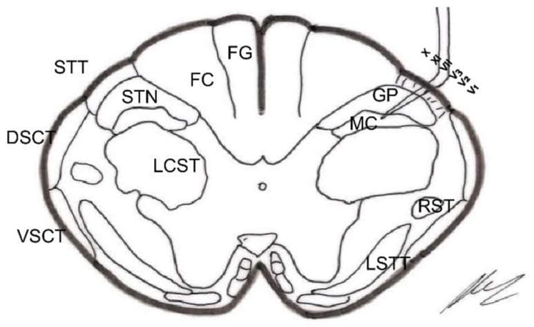 This medical anatomical diagram illustrates a cross-section of the spinal cord (medulla oblongata level, approximately 18 mm below the obex), specifically focusing on the neuroanatomical structures targeted during a trigeminal nucleotomy. The diagram highlights both white matter tracts and gray matter nuclei. In the posterior column, the Fasciculus Gracilis (FG) is medially positioned, while the Fasciculus Cuneatus (FC) is lateral to it. The lateral white matter contains the Lateral Corticospinal Tract (LCST), Dorsal Spinocerebellar Tract (DSCT), and Ventral Spinocerebellar Tract (VSCT). On the right side of the diagram, a surgical probe is shown penetrating the Spinal Trigeminal Tract (STT/STrigT) to target the Spinal Trigeminal Nucleus (STN), specifically indicating the Gelatinosa Portion (GP) and the Magnocellular Portion (MC). Other notable structures include the Rubrospinal Tract (RST) and the Lateral Spinothalamic Tract (LSTT). This illustration is designed for neurosurgical education, demonstrating the spatial relationships necessary for selective destruction of pain-transmitting nuclei in the brainstem and upper cervical spinal cord.