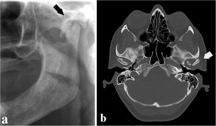 This composite educational image illustrates an intracapsular mandibular fracture through two diagnostic imaging modalities. Image A is a cropped panoramic radiograph (orthopantomogram) focusing on the left temporomandibular joint (TMJ) region. It demonstrates a distinct radiolucent oblique line (arrow) traversing the condylar head, indicating a fracture that compromises the articular surface. Image B is a computed tomography (CT) axial section at the level of the skull base, providing cross-sectional detail of the same injury. The CT scan confirms an oblique fracture rhyme (arrow) within the condylar head. While the condyle remains situated within the glenoid fossa, there is clear discontinuity of the cortical bone and involvement of the articular facet. This presentation is characteristic of an intracapsular condylar head fracture, typically resulting from vertical compressive forces. The images serve as an educational comparison between 2D screening radiography and 3D diagnostic imaging for assessing maxillofacial trauma and joint integrity.