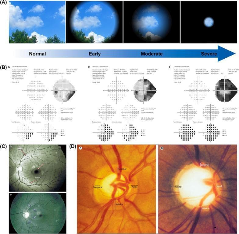 This composite educational graphic illustrates the progression and diagnostic findings of glaucoma across four panels (A-D). Panel A presents a visual simulation of disease progression, showing normal vision, peripheral blurring in early stages, and advanced 'tunnel vision.' Panel B displays Automated Static Perimetry (visual field tests) categorized as early, moderate, and severe functional loss, demonstrating increasing scotoma size and pattern deviation. Panel C contains two ophthalmoscopic photographs highlighting the retinal nerve fiber layer (RNFL); the healthy eye (A) shows intact reflexes (red arrows), whereas the glaucomatous eye (B) exhibits localized defects and reduced reflexes (light blue arrows). Panel D provides a detailed comparison of the optic disc: the healthy disc (A) shows a normal neuroretinal rim with characteristic inferior thickening, while the glaucomatous disc (B) demonstrates advanced pathological cupping, characterized by a significantly larger, deeper cup and thinned neuroretinal rim. This visual summarizes the correlation between structural damage (RNFL and optic disc) and functional vision loss in glaucoma.