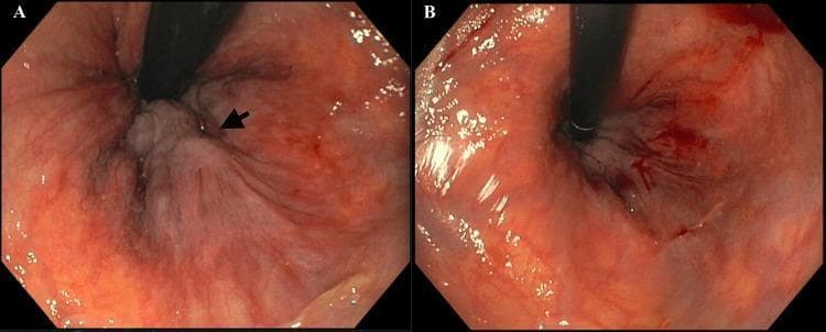 This endoscopic clinical photograph demonstrates Grade III internal hemorrhoids within the rectum before and after sclerotherapy treatment. Image A (pre-treatment) shows a retroflexed view of the anal canal where a prominent, swollen, pale-gray mass is visible, indicated by a black arrow. The hemorrhoid exhibits an irregular, nodular surface texture with dark vertical vascular striations, protruding into the lumen from the surrounding reddish-pink rectal mucosa. Image B (post-treatment) displays the clinical response following sclerotherapy. There is a marked reduction in the size and protrusion of the hemorrhoidal tissue. The previously bulky mass appears flattened and less congested, although some minor surface blood and residual dark vascular markings remain visible. This comparison illustrates the efficacy of sclerotherapy in reducing the volume and vascularity of prolapsing internal hemorrhoidal disease, which is a common minimally invasive intervention for symptomatic, non-bleeding Grade II and III hemorrhoids.