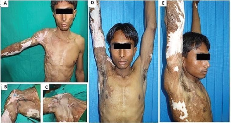 This composite of clinical photographs illustrates the surgical management of a Type 1a right axillary contracture resulting from thermal burns. Panel A shows the preoperative state, characterized by extensive hypertrophic scarring with mixed hyperpigmentation and hypopigmentation (vitiliginous areas) across the anterior chest and right arm, causing significant restriction in shoulder abduction. Panel B demonstrates the preoperative marking for a square flap technique, a modified Z-plasty designed to maximize tissue lengthening. Panel C displays the immediate postoperative appearance with the square flap advanced and triangular flaps transposed to release the contracture. Panels D (frontal) and E (lateral) show the long-term follow-up at 1.5 years, demonstrating a successful clinical outcome with full 180-degree shoulder abduction. The skin in the reconstructed axilla shows improved texture and elasticity, although residual post-burn pigmentary changes persist on the adjacent trunk and extremity. This sequence serves as an educational resource for plastic and reconstructive surgery, highlighting local flap techniques for post-burn scar contracture release.