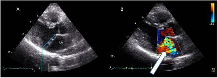 This diagnostic image consists of two panels (A and B) showing transthoracic echocardiography (TTE) in a parasternal long-axis (PLAX) view, demonstrating mitral valve prolapse (MVP). Panel A is a 2D grayscale image showing the anatomical relationship between the mitral valve leaflets and the left atrium (LA). A blue reference line marks the mitral annular plane; systolic billowing of the mitral leaflets exceeds this line by >2 mm, diagnostic of MVP. Panel B displays color Doppler imaging during systole. A large, eccentric, multi-colored (mosaic) jet originates from the mitral orifice and extends deep into the left atrium (indicated by a white arrow), signifying severe mitral regurgitation. The image illustrates key diagnostic criteria for myxomatous valve disease, emphasizing the displacement of leaflet tissue beyond the saddle-shaped annulus and the resultant functional hemodynamic impairment. This material is suited for cardiovascular education regarding valvular heart disease and echocardiographic interpretation.