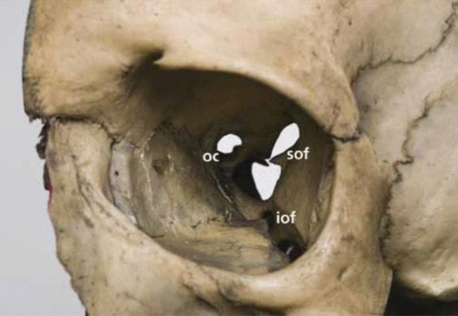 This clinical photograph of a human dry skull specimen provides an anterior view of the right orbit, highlighting the critical foramina and fissures of the orbital apex and walls. Three primary openings are labeled: the optic canal (OC), the superior orbital fissure (SOF), and the inferior orbital fissure (IOF). The optic canal is depicted as a rounded opening in the lesser wing of the sphenoid bone, positioned superiorly and medially. Inferolateral to the optic canal is the superior orbital fissure, which exhibits a characteristic comma-shaped or 'racket' morphology, wider at its base and tapering as it extends superolaterally between the greater and lesser wings of the sphenoid. Positioned below the SOF, along the floor and lateral wall junction, is the inferior orbital fissure, shown as an elongated, slit-like gap. The image serves as an educational anatomical reference for understanding the spatial relationships of the orbital apex, specifically the arrangement of neurovascular passages including the optic nerve, ophthalmic artery, and cranial nerves III, IV, V1, and VI.
