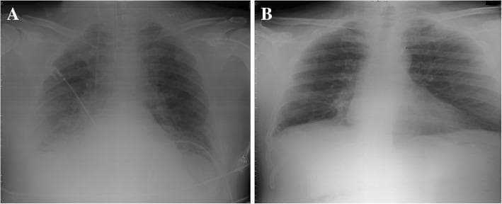 This comparison chart features two chest X-rays (CXR) illustrating the clinical progression and resolution of pulmonary pathology. Image A is a supine anteroposterior (AP) chest X-ray obtained in an intensive care unit (ICU) setting. It demonstrates a prominent right-sided basal pulmonary infiltrate, characterized by increased opacity and haziness in the lower lung field, partially obscuring the diaphragm and pulmonary vasculature. Medical devices, including a central venous catheter or monitoring line, are visible traversing the left hemithorax, reflecting the patient's acute clinical status. Image B is a posteroanterior (PA) chest X-ray taken prior to discharge. It shows a complete resolution of the previously seen basal infiltrate. The lung fields appear radiolucent and clear, with well-defined costophrenic angles and visible pulmonary markings. This side-by-side comparison is intended for medical education to demonstrate radiographic signs of pulmonary consolidation (such as those associated with pulmonary embolism or pneumonia) and subsequent improvement following therapeutic intervention.