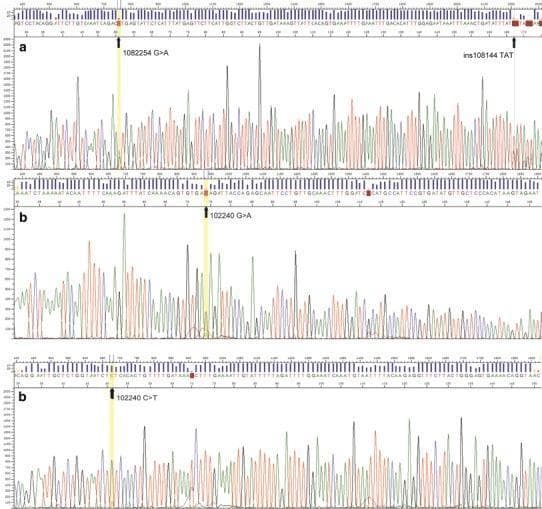 This diagnostic image displays Sanger sequencing chromatograms identifying genetic mutations in the ADAM3A gene. Panel (a) shows the sequence for Case 5 (positions 108223–108282 bp) in reverse orientation, highlighting a 108225 G>A single nucleotide substitution and a TAT insertion at position 108114 (ins108114). Panels (b) present the sequencing results for Case 12 (positions 102217–102276 bp). The upper part of panel (b) shows the forward orientation with a 102240 G>A mutation, while the lower part shows the reverse orientation confirming the corresponding 102240 C>T mutation. The chromatograms feature distinct color-coded fluorescent peaks (adenine, thymine, cytosine, and guanine) with signal intensity on the y-axis and nucleotide position on the x-axis. Vertical yellow shading and black arrows pinpoint the exact locations of the mutations. These findings are clinically relevant to the molecular characterization of extranodal NK/T-cell lymphoma (NK/TCL) and the investigation of chromosomal aberrations at the 8p11.23 locus.