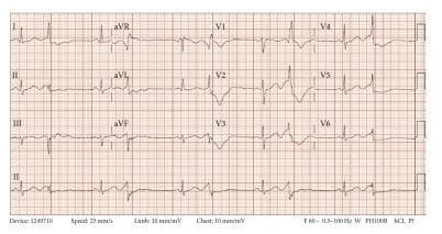 A 12-lead electrocardiogram (EKG) demonstrating a diagnostic pattern of ventricular bigeminy. The tracing reveals a regularly irregular rhythm where every sinus beat is followed by a premature ventricular complex (PVC). The sinus beats show a relatively narrow QRS morphology, while the PVCs are characterized by wide, bizarre QRS complexes with high amplitude and T-wave discordance. Notably, the EKG exhibits a significantly prolonged QTc interval of approximately 550 ms, indicating delayed ventricular repolarization. The precordial leads (V1-V6) show prominent morphological differences between the conducted and ectopic beats, with the PVCs displaying an altered axis and sequence of depolarization. This clinical diagnostic image is used to illustrate electrolyte imbalances or drug-induced long QT syndrome leading to ventricular ectopy and increased risk of Torsades de Pointes. The tracing includes limb leads (I, II, III, aVR, aVL, aVF) and precordial leads, providing a comprehensive view of the cardiac electrical activity.