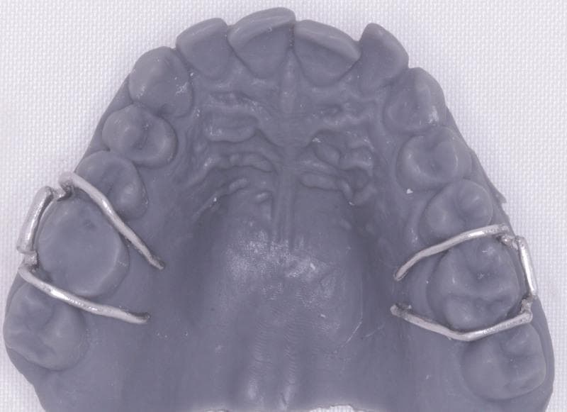 This clinical photograph displays a gray 3D-printed resin model of a human maxillary (upper) dental arch, used for orthodontic appliance fabrication. The model exhibits a matte finish with visible anatomical details, including the dentition and palatal rugae. Fitted onto the bilateral first molars are metallic Adams clasps, which are key components for the retention of removable orthodontic appliances. Each clasp consists of a horizontal bridge segment positioned on the buccal surface, connected to two arrowheads that engage the mesiobuccal and distobuccal undercuts of the molar. The metal tags of the clasps extend over the occlusal embrasures into the palatal region, designed for eventual embedding into an acrylic baseplate. The image demonstrates the integration of digital dentistry, specifically intraoral scanning and 3D printing, with traditional cobalt-chromium (Co-Cr) alloy laboratory components to ensure precise fit and retention of a Hawley retainer or similar removable dental device.