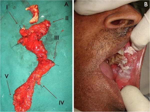 The image consists of two panels illustrating the surgical management of oral squamous cell carcinoma. Panel A is a clinical photograph showing resected surgical specimens from a neck dissection, laid out on a green sterile field. Five anatomical levels of cervical lymph nodes (Levels I–V) are labeled with Roman numerals. For surgical pathology orientation, the specimens are marked with varying numbers of black silk sutures: one for Level I through five for Level V. The specimens exhibit characteristic fatty and lymphoid tissue morphology. Panel B is a clinical photograph of the oral cavity of a 51-year-old patient. It displays a large, exophytic, and proliferative tumor of the buccal mucosa. The lesion exhibits a heterogeneous appearance with mixed leukoplakic (white) and erythroleukoplakic (red-white) areas, a rough verrucous surface, and irregular borders, contrasting sharply with the surrounding healthy pink mucosa. This composite demonstrates the clinical presentation of buccal squamous cell carcinoma and the subsequent regional lymph node staging via radical or selective neck dissection.
