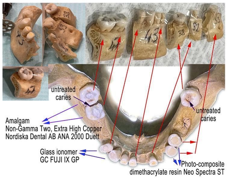 A clinical photograph and forensic diagram illustrating a human mandible used in dental material research. The image displays the mandible in several states: as a whole anatomical structure and subsequently divided into five labeled segments (47, 43, 38, 32, and 33) for experimental degradation studies. Key educational features include the identification of three types of dental restorative materials: silver-toned Amalgam (Nordiska Dental AB ANA 2000), white Glass Ionomer (GC FUJI IX GP), and tooth-colored Photo-composite (dimethacrylate resin Neo Spectra ST). Red arrows link the partitioned segments to their original locations in the dental arch. Additionally, the image points out pathological features such as untreated dental caries, visible as dark occlusal discolorations. The content serves to demonstrate forensic odontological methods, the visual morphology of different dental fillings, and the structural integrity of mandibular bone and dentition under experimental conditions.