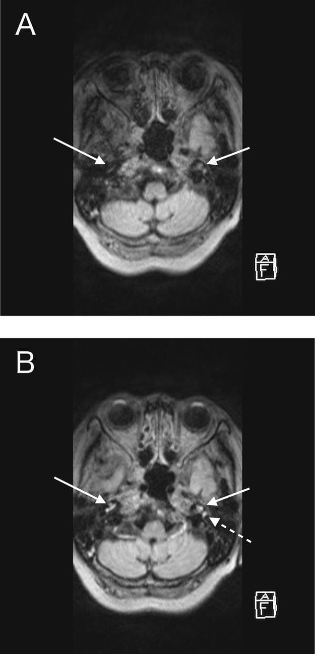 This diagnostic image consists of two axial magnetic resonance imaging (MRI) views of the head at the level of the inner ear. Panel A shows a non-enhanced Fluid-Attenuated Inversion Recovery (FLAIR) sequence, where the cochleae and semicircular canals (indicated by white solid arrows) appear isointense, blending with the surrounding petrous temporal bone structures. Panel B displays a contrast-enhanced FLAIR (CE-FLAIR) image, revealing prominent bilateral pathological enhancement within the cochleae (solid arrows) and the semicircular canals (dashed arrow). This comparative finding is clinically significant for identifying labyrinthitis or inflammatory processes associated with systemic conditions such as granulomatosis with polyangiitis (GPA). The imaging demonstrates the high sensitivity of the CE-FLAIR modality in detecting blood-labyrinth barrier breakdown compared to standard non-enhanced sequences.