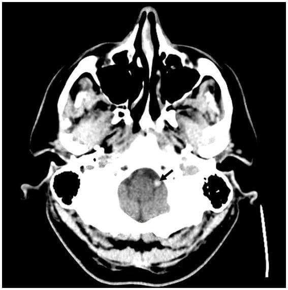 This diagnostic image is an axial non-contrast computed tomography (CT) scan of the head at the level of the posterior fossa. The image displays the skull base, facial bones, and intracranial contents. The cerebellum and brainstem are visible with normal gray-matter density. A key finding is indicated by a black arrow pointing to the left intracranial vertebral artery, which exhibits a distinct 'hyperdense vessel sign'. This hyperdensity, appearing brighter (more opaque) than typical intravascular blood and the surrounding brain parenchyma, is a radiographic marker often associated with acute thromboembolic occlusion. No obvious acute intracranial hemorrhage or midline shift is observed at this level. This visual evidence is clinically significant for the early diagnosis of acute ischemic stroke within the posterior circulation, specifically involving the vertebral artery.