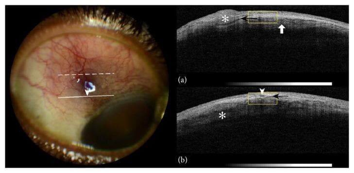 This composite educational image features a color photograph and corresponding Anterior Segment Optical Coherence Tomography (AS-OCT) scans of a right eye, illustrating clinical signs of nodular episcleritis and scleritis. The color photograph reveals marked violaceous ocular injection, superficial blood vessel congestion, and a localized nodular thickening approximately 4mm from the limbus. AS-OCT cross-sections (a) and (b) provide detailed visualization of the underlying tissue architecture. Key findings include nodular episcleral thickening (asterisk), a subepiscleral fluid level presenting as a hyporeflective space (black arrow), and intlamellar scleral edema (white arrow/asterisk). These OCT features correlate with the clinical appearance of vessel dilation and deep tissue inflammation. The image serves as a diagnostic reference for identifying inflammatory eye conditions using both external photography and non-invasive cross-sectional imaging, highlighting the relationship between visible clinical signs and internal structural alterations like scleral lamellae bisection by hyporeflective fluid.