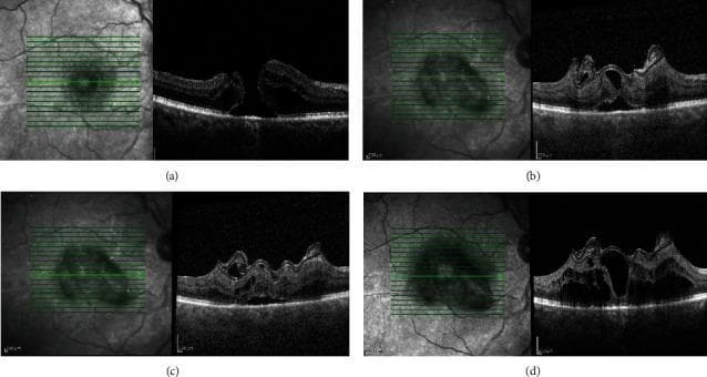 This diagnostic image series displays vertical Spectral-Domain Optical Coherence Tomography (SD-OCT) scans and corresponding infrared fundus images tracking the repair of a large macular hole (MH) using an anterior lens capsular flap transplant. The series is divided into four chronological stages: (a) Baseline, showing a full-thickness macular hole with distinct retinal layer disruption and subretinal fluid; (b) One month postoperatively, demonstrating initial closure with the hyperreflective capsular flap bridging the defect; (c) Six months postoperatively, showing further tissue integration and thickening at the foveal site; and (d) 12 months postoperatively, illustrating anatomical closure and foveal contour reorganization. The scans highlight the gradual restoration of retinal architecture, although some irregularities in the outer retinal layers persist. This sequence serves as an educational tool for ophthalmology residents to understand surgical outcomes and tissue remodeling in advanced macular hole management using autologous transplantation techniques. The imaging provides evidence of the flap acting as a scaffold for cellular migration and structural bridging.