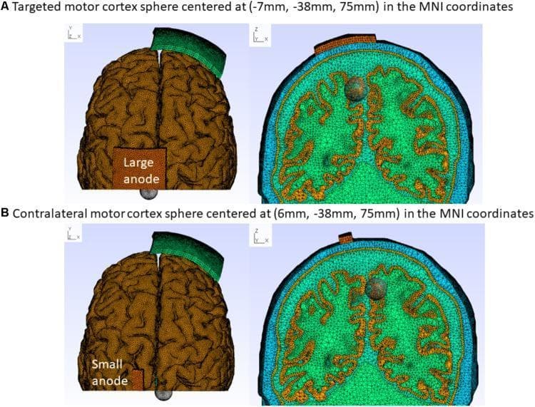 Educational diagram illustrating finite element method (FEM) head models for transcranial Direct Current Stimulation (tDCS) research. The figure shows the Colin27 head model used to analyze electric field distribution in the motor cortex. It is organized into two rows: (A) demonstrates a 'Large-anode' montage (5 cm x 7 cm) and (B) demonstrates a 'Small-anode' montage (3.5 cm x 1 cm). The left panels provide a superior (top) view of the cortical surface mesh, highlighting the anode placement (orange rectangle) relative to a cathode (green band) and a target grey sphere representing a 1 cm radius cortical tissue cluster. Row A targets the motor cortex at MNI coordinates (-7mm, -38mm, 75mm), while row B focuses on the contralateral leg motor cortex at (6mm, -38mm, 75mm). The right panels present coronal cross-sections of the FEM mesh, visualizing the internal brain geometry, sulci, and gyri using a triangular mesh discretization. This visual resource is used to compare how different electrode sizes and spatial coordinates affect targeted neurostimulation in clinical neurology and biomedical engineering applications.