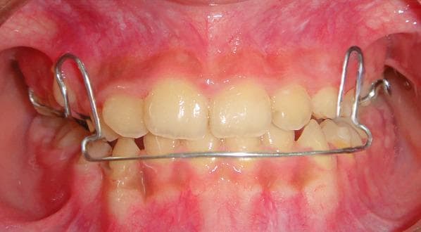 This clinical intraoral photograph displays a removable mandibular retractor (RMR) appliance in situ within a pediatric patient's oral cavity. The appliance features a metal wire framework that originates from the maxillary arch and extends inferiorly to the mandible. A prominent labial bow wire spans the lower anterior teeth, positioned at their cervical regions near the gingival margin. Vertical loop-like wire components are visible laterally, which facilitate force distribution and provide structural stability. The image illustrates a frontal occlusal view showing the interaction between the orthodontic hardware and the primary/early mixed dentition. The appliance is typically utilized in the second phase of treatment for skeletal Class III malocclusions, following active maxillary expansion or facemask therapy, to maintain the corrected overjet and molar relationships. The gingival tissues appear healthy, and the appliance is designed to avoid occlusal interference while exerting posterior force on the mandibular arch.