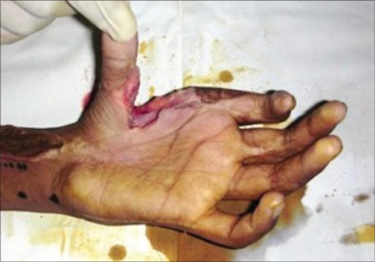 Clinical photograph of a human hand showing a surgical soft tissue defect following the release of a post-burn contracture in the first web space. The image depicts the hand in a supinated position, revealing an open surgical site between the thumb and index finger. The defect has irregular, slightly raised edges with exposed red underlying tissue, likely muscle or deep dermis. Linear hyperpigmented scars and markings are visible along the volar aspect of the wrist and palm, consistent with chronic burn sequelae. The thumb is being manually extended by a gloved hand to demonstrate the restored range of motion in the web space. This visual serves as a pre-operative or intra-operative educational tool for plastic and reconstructive surgery, illustrating the management of hand contractures and the preparation of a recipient site for subsequent flap coverage.