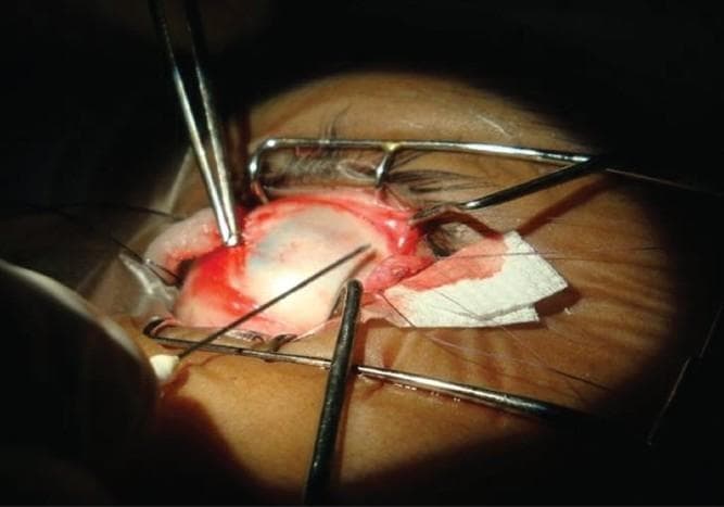 This clinical intraoperative photograph illustrates a surgical procedure on a human eye, likely a strabismus correction. An eyelid speculum is in place to provide surgical exposure of the globe and sclera. The surgical field demonstrates a disinserted extraocular muscle being prepared for recession. Metal surgical forceps are visible, retracting the conjunctiva and stabilizing the globe. A 25-gauge needle is positioned at the cut edge of the muscle belly, applying a clear liquid bioadhesive, specifically iso-amyl cyanoacrylate, to facilitate sutureless reattachment to the sclera. Key anatomical landmarks include the white scleral surface, the vascularized conjunctival edges, and the reddish muscle tissue. Pre-placed 6-0 Vicryl sutures are visible at the muscle edge, serving as a safety measure for the adhesion process. A blood-stained cellulose sponge is located adjacent to the surgical site for moisture control. This image serves as an educational resource for ophthalmic surgeons and students, demonstrating alternative tissue-fixation techniques in extraocular muscle surgery.