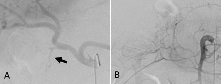 Two diagnostic angiograms (a and b) demonstrating normal arterial anatomy of the upper gastrointestinal region. Image (a) is a selective celiac trunk angiogram showing the celiac artery and its major branches: the tortuous splenic artery extending to the left and the hepatic artery giving rise to the gastroduodenal artery (GDA), indicated by a black arrow. Image (b) shows the superior mesenteric artery (SMA) and the origin of the inferior pancreaticoduodenal artery (IPDA). Both images demonstrate smooth arterial contours with uniform contrast opacification. There are no visual signs of vascular pathology, such as pseudoaneurysms, arterial stenosis, or active contrast extravasation (hemorrhage). This set of images serves as a clinical reference for normal mesenteric and celiac vasculature in the context of screening for postoperative complications like visceral artery pseudoaneurysms.