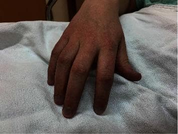 A clinical photograph of a patient's hand resting on a white hospital drape, demonstrating generalized peripheral cyanosis. The dorsal surface of the hand, knuckles, and all fingers exhibit a distinct, pervasive dusky bluish-purple or slate-gray hue. This discoloration is notably uniform across the skin and extends to the nail beds, which appear darkly cyanotic. The image serves as a clinical illustration of central or peripheral cyanosis, specifically associated with congenital methemoglobinemia, a condition where elevated levels of methemoglobin reduce the blood's oxygen-carrying capacity, resulting in characteristic skin and extremity discoloration despite normal arterial oxygen tension. The photograph highlights the visual presentation of 'chocolate-colored' blood manifesting as cutaneous cyanosis in a clinical setting.