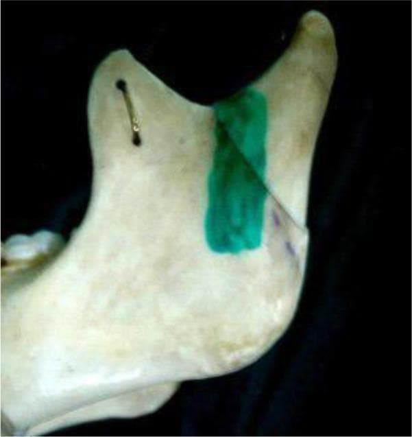This clinical photograph of a dry human mandible specimen illustrates a subcondylar fracture and its surgical reduction line according to the Shirani method. The specimen shows the left ramus and condylar process against a dark background. A diagonal fracture line is clearly visible, extending from the mandibular notch down toward the posterior border of the ramus. This osteotomy or fracture reduction line is highlighted with a thick, vibrant green dye to indicate the anatomical pathway for surgical correction. A small metallic wire or staple is inserted through two burr holes on the coronoid process, demonstrating a method of fixation or stabilization. The bone specimen exhibits an off-white, matte texture characteristic of preserved anatomical models used in maxillofacial surgery education. This image serves as a teaching aid for understanding the topographical landmarks and surgical approaches for treating mandibular subcondylar fractures in oral and maxillofacial surgery.
